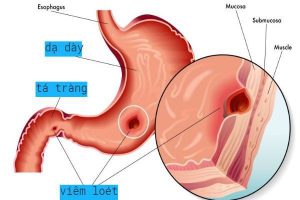 Điều cần làm để phòng ngừa viêm loét dạ dày tá tràng