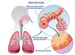 Giải pháp nào cho bệnh viêm đường hô hấp vào mùa Hè?