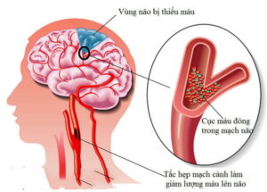 Cảnh giác với cơn thiếu máu não thoáng qua( TIA)